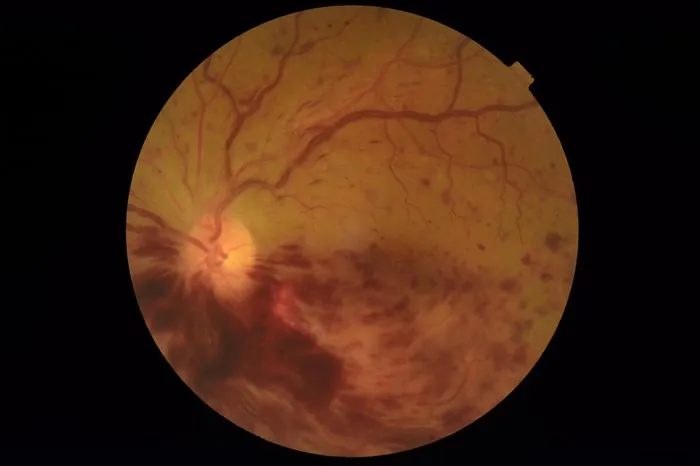 Hemorragia retiniana por oclusão de veia — imagem de retinografia — Oculare Medical Center Caruaru