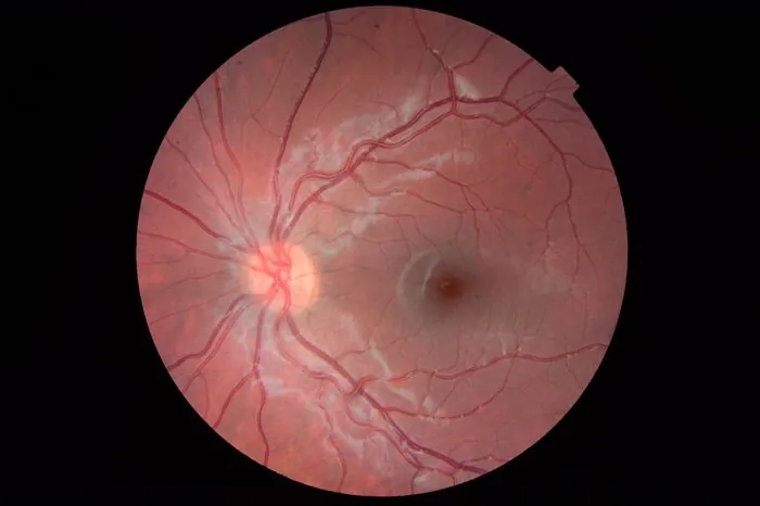 Retinografia normal — fundo do olho saudável — Oculare Medical Center Caruaru